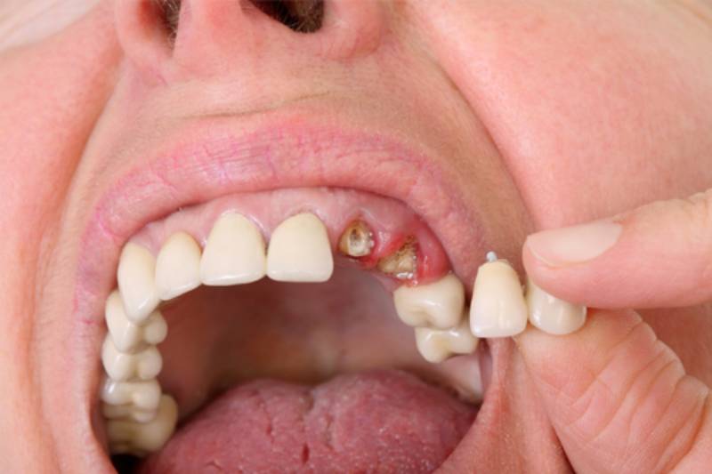 Giấc mơ thấy rụng răng có ý nghĩa gì trong tâm linh và đời sống?