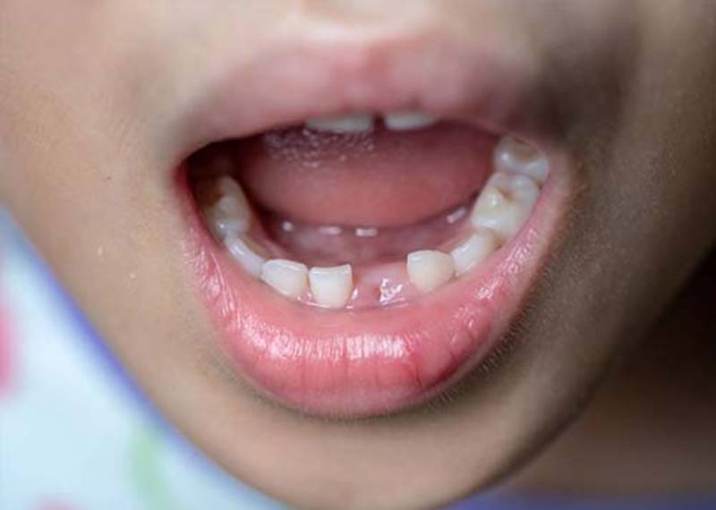 Lời khuyên khi gặp giấc mơ rụng răng