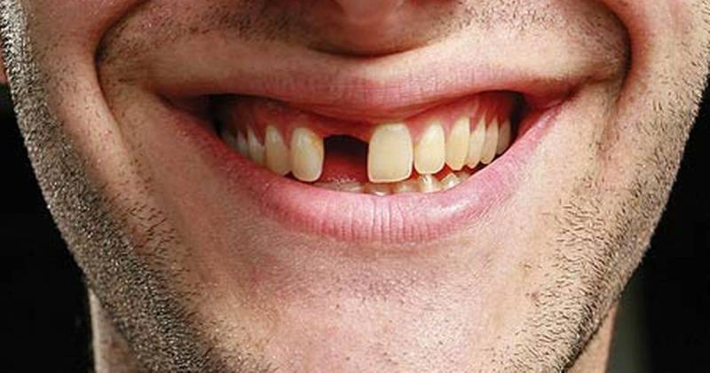 Vì sao giấc mơ rụng răng lại phổ biến đến vậy?